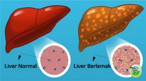 cara mengobati penyakit liver, tips herbal tazakka